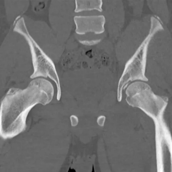 CECT Left Hip Joint